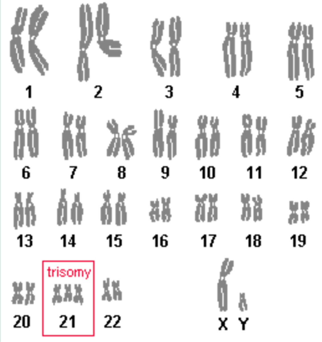 <p>One of most common genetic disorder caused by chromosomal abnormality; babies born with three copies of chromosome 21; 90% cases the extra chromosome comes from the egg; affects 1 out of every 800 - 1000 babies born; occurs more frequently in women older than 35; symptoms include flat face, small broad nose, abnormal ears, large tongue, upward slanting eyes with small folds; increased risk of developing respiratory infections, gastro-intestinal obstructions, leukemia, heart defects, moderate to severe mental retardation; decreased life expectancy → only ½ live to 50</p>