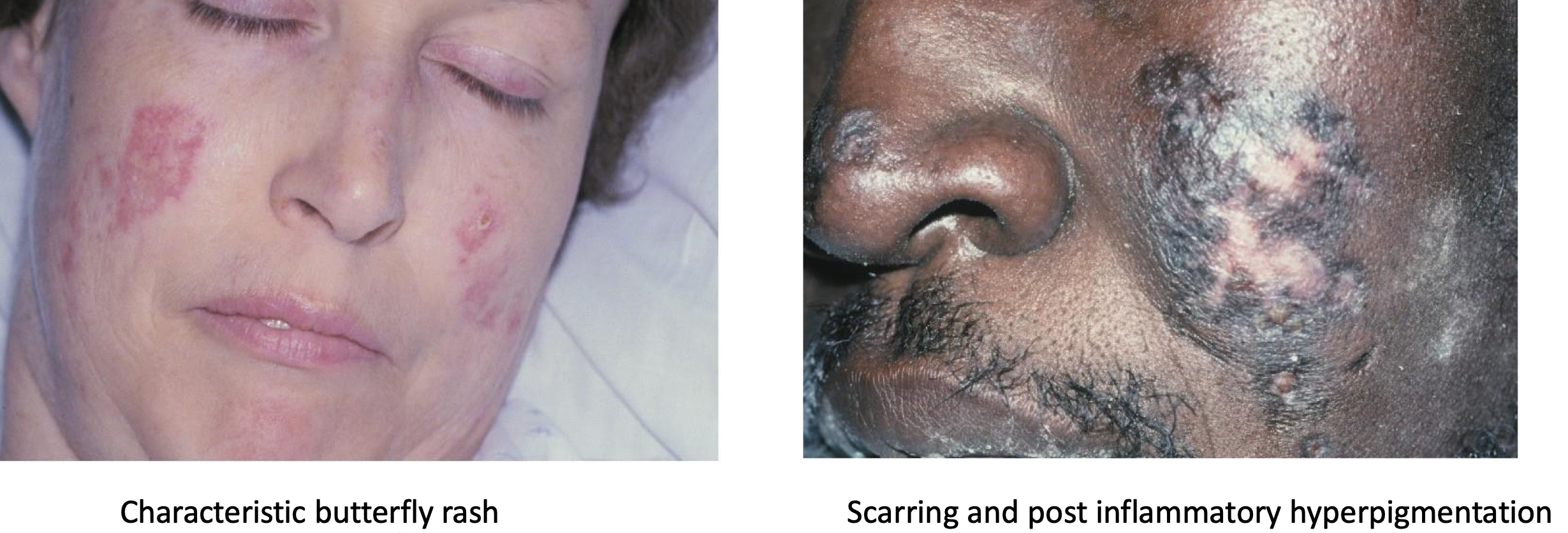 <p>which autoimmune/immune-mediated/allergic lesion:</p>