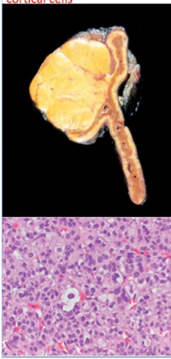 <p>Define Condition:</p><p>BENIGN; Most are NONFUNCTIONAL (90%)</p><p>-Hx: Found incidentally (incidentalomas)</p><p>-Dx:</p><p>&gt; Gross:</p><p>&gt;&gt; Well-circumscribed yellow tumor with capsule</p><p>&gt;&gt; Small (1-2 cm)</p><p>&gt; Micro: Cells similar to cells found in zona fasciculata</p>