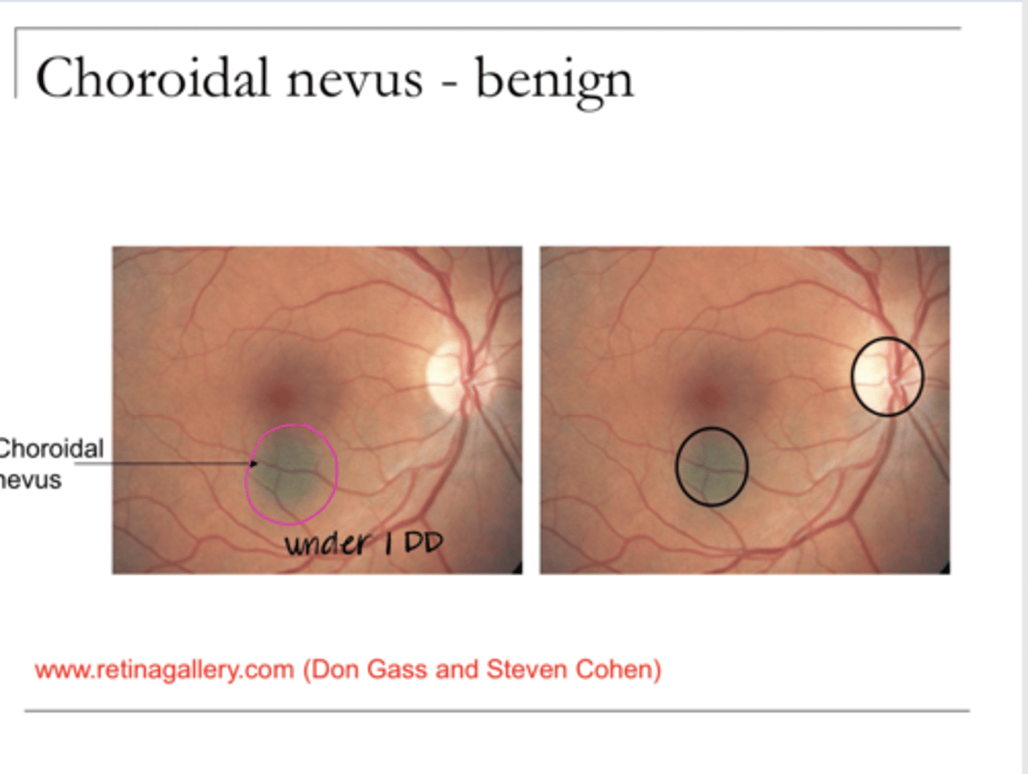 <p>Is a nevus benign or malignant?</p>