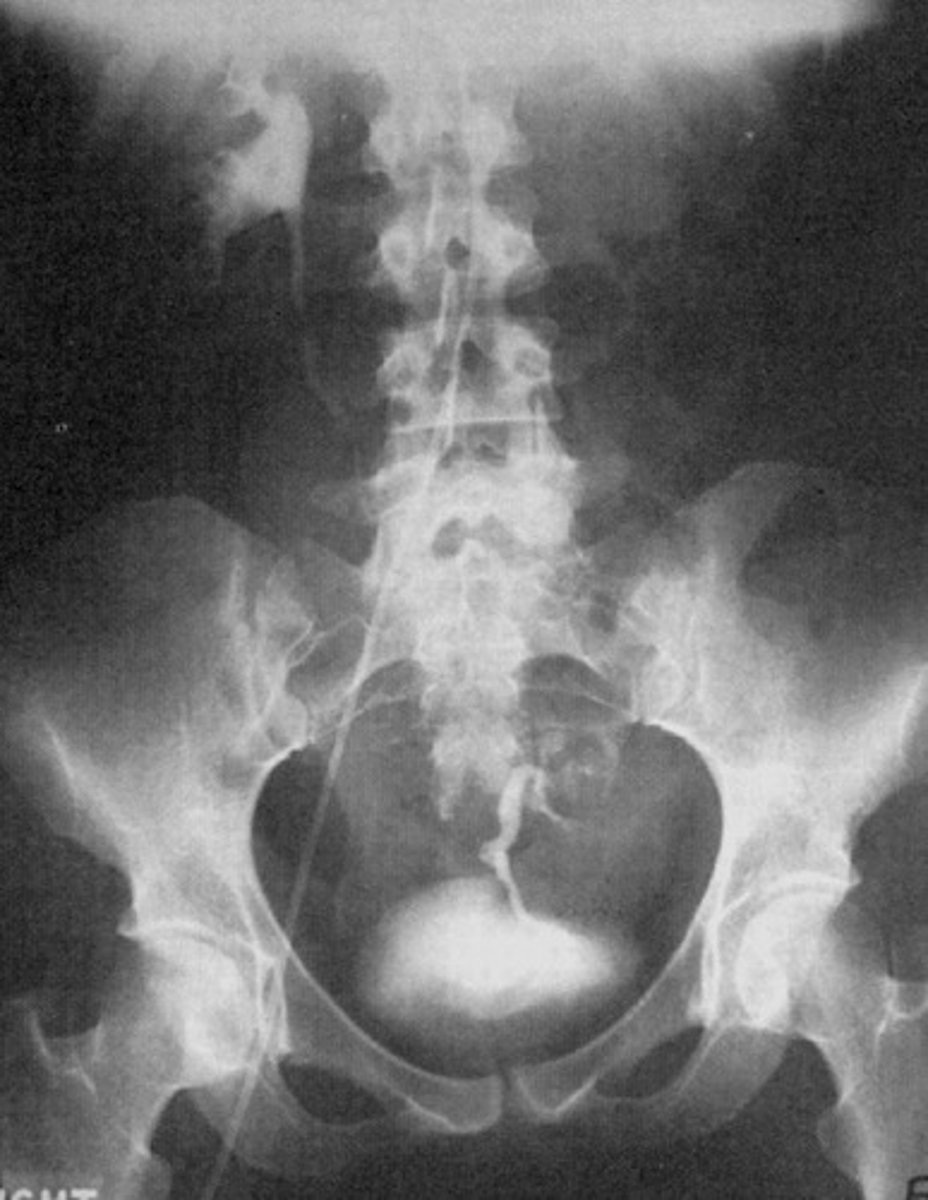 <p>- What congenital anomaly refers to a type of ectopic kidney that is located in the pelvis and has a short ureter?</p><p>- When patients need a renal transplant, where are they placed?</p>