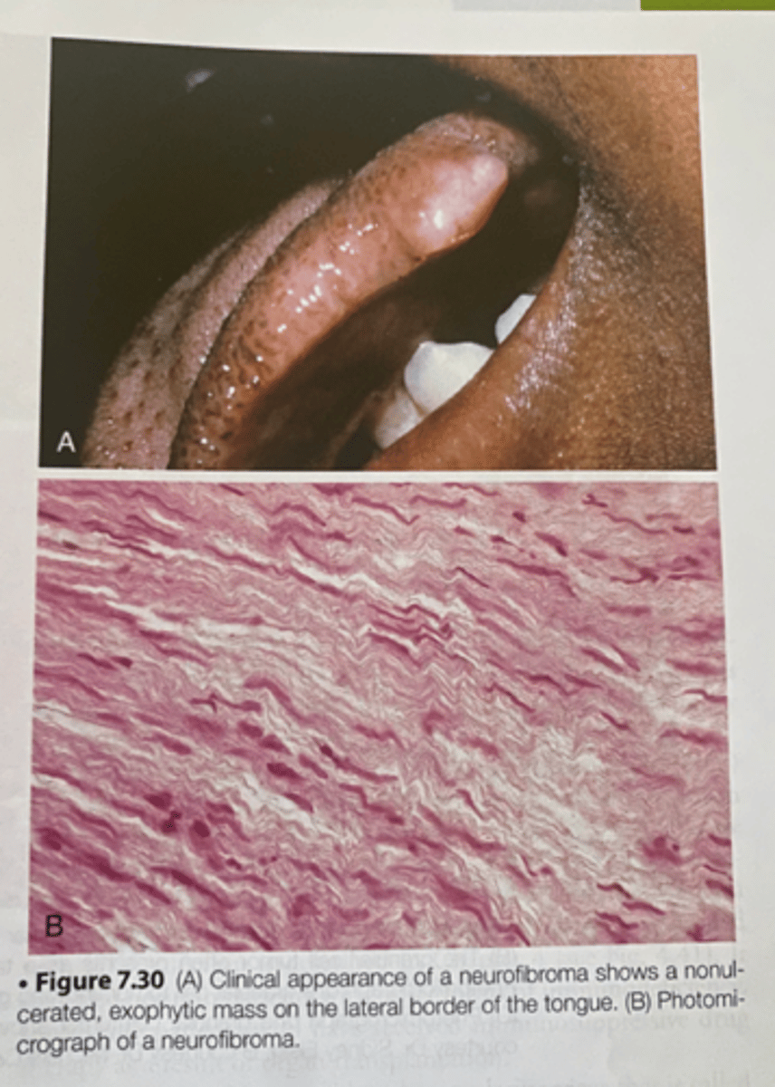 <p>-a nonulcerated ,exophytic mass on the lateral border of the tongue</p><p>-benign tumor derived from nerve tissue</p>