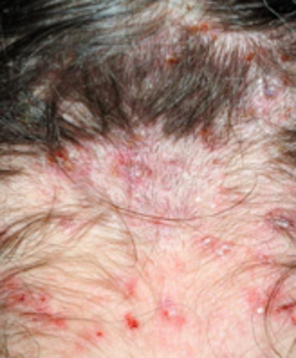 <p>Parasitic ID:</p><p>Subjective:</p><p>- Pruritus of scalp and neck as an allergic reaction to live saliva injected during feeding</p><p>- Onset of itching may be delayed until sensitization occurs after 4-6 weeks</p><p>Objective:</p><p>- nits may be visible on scalp and hair shaft</p><p>- Excoriations may be visible on scalp, neck, and postauricular skin</p><p>- Secondary staph infection occurs with associated cervical and nuchal lymph node enlargement</p>