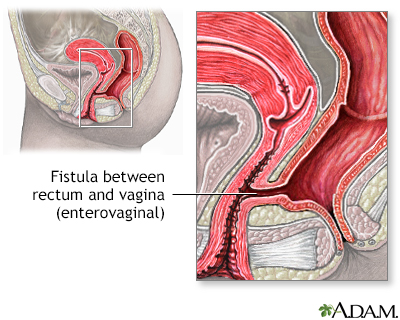 <p>def. an abnormal tube-like passage from one cavity to another </p>
