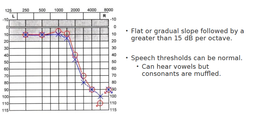 <p>“Normal through 1500 Hz precipitously sloping to profound hearing loss bilaterally”</p>