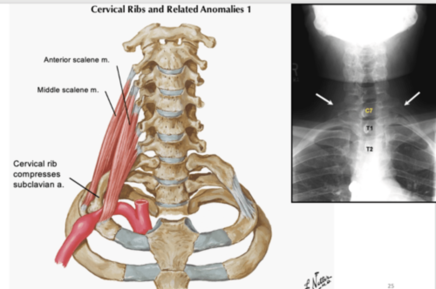 <p>cervical rib</p><p>-can compress subclavian artery leading to ischemia (reduced blood supply) to upper limb</p>