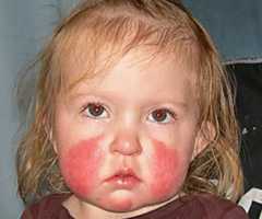 <p><strong>before rash:</strong> fever, runny nose, headache</p><p style="text-align: left;"><strong>rash:</strong> red rash to face <strong>(slapped cheek appearence)</strong>, maculopapular red spots</p>