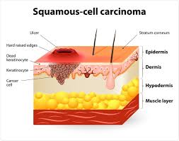 <p>RF: sun exposure<br>fair skin<br>HPV infection<br>radiation exposure<br>sunburns</p><p>E: 2nd most common skin cancer<br>actinic keratosis<br>sun-exposed areas<br>chronic trauma<br>inflammation<br>genitalia<br>oral mucosa</p><p>CM:</p><p><u>bowen’s disease:</u> SCC in situ</p><p><u>keratoacanthoma (KA):</u><br>appears suddenly<br>grows rapidly</p><p>TX:<br>mohs surgery<br>surgical excision<br>in-situ→electrodessication and curretage (ED&amp;C)<br>no surgery→radiation therapy</p><p>P: 45%→metastasis<br>early intervention→high cure rate</p>