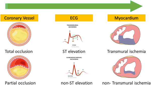 <p>Resulting from a<strong> complete occlusion of a coronary arter</strong>y, leading to <strong>transmural infarction</strong> where the<strong> entire thickness of the heart muscle is affected.</strong></p>