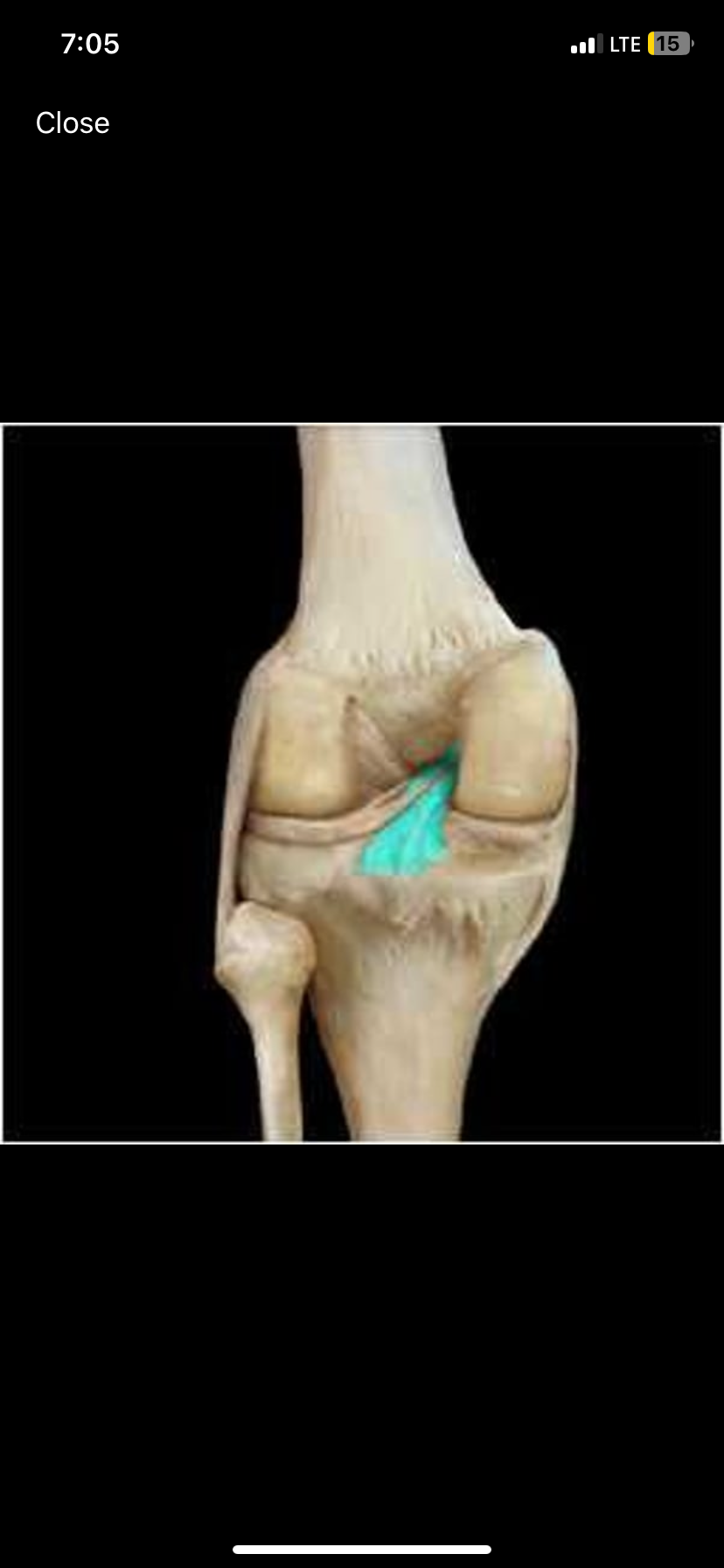 <p>An important ligament within the knee joint, preventing posterior displacement of the tibia.</p>