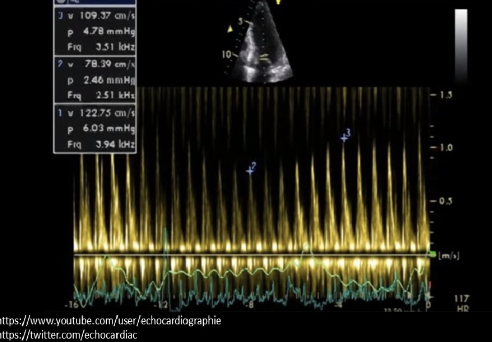 <p>The Doppler tracing is consistent with which of the following cardiac abnormalities? </p>