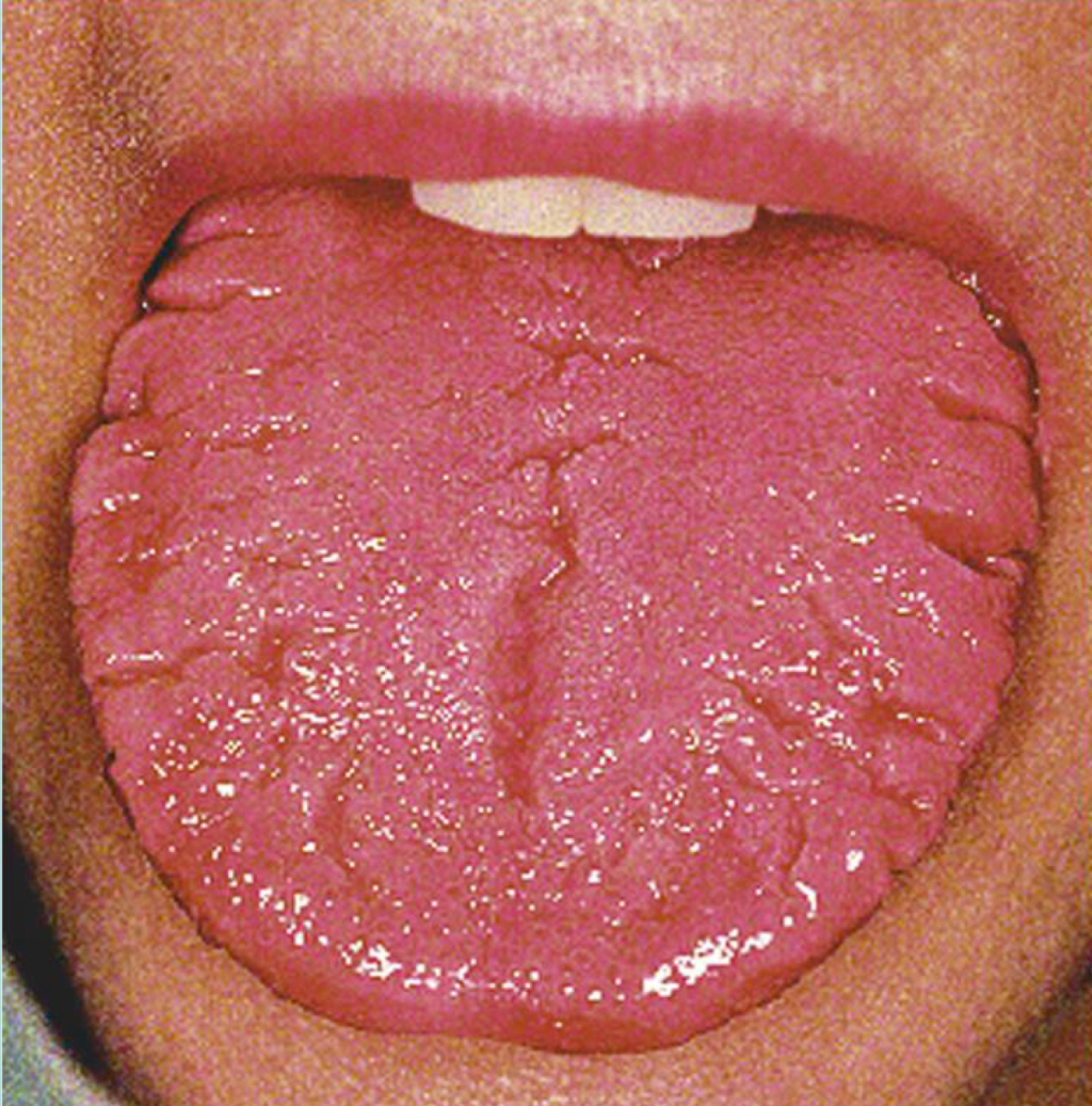 <p>Fissured tongue </p>