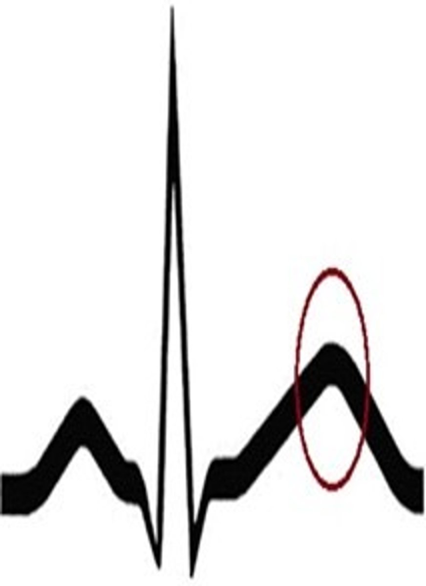 <p>ID the EKG Deflection</p>