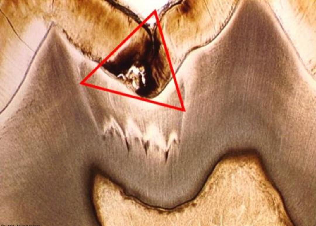 <p>what kind of enamel caries is this?</p>