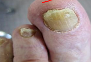 <p>a fungal infection of the nails. </p>