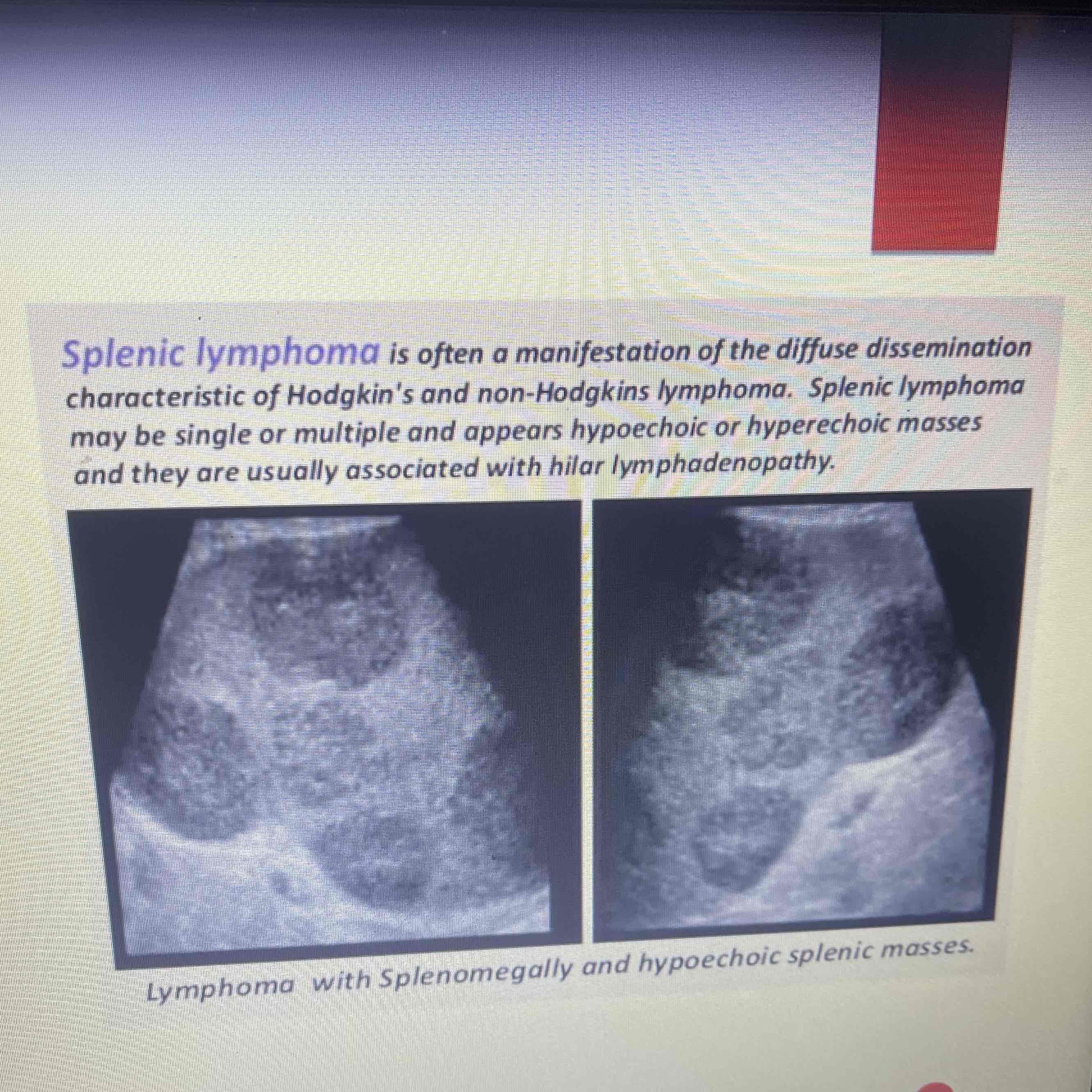 <ul><li><p>Spleen is most commonly involved organ</p></li><li><p>MC malignant tumor is Hodgkin and non-Hodgkin’s</p></li><li><p>Clinically: history of ca</p></li><li><p>Sonographic: Difficult to visualize on ultrasound, bulky disease, focal or diffuse lesions, splenomegaly may occur, AIDS Lymphoma: Uniform decreased echogenicity or focal hyperechoic lesions</p></li></ul>