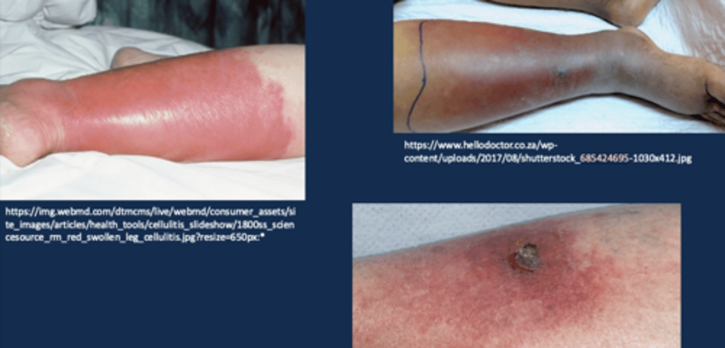 <p>Redness, pain, swelling &amp; heat [rubor, dolor, tumour, calor]</p>