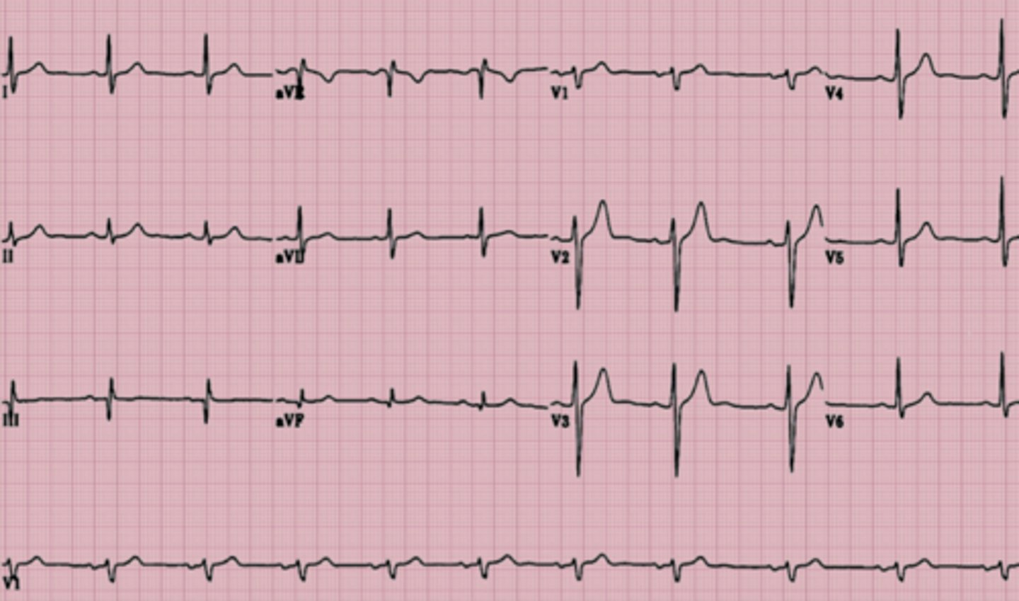 <p>What is the rhythm</p>
