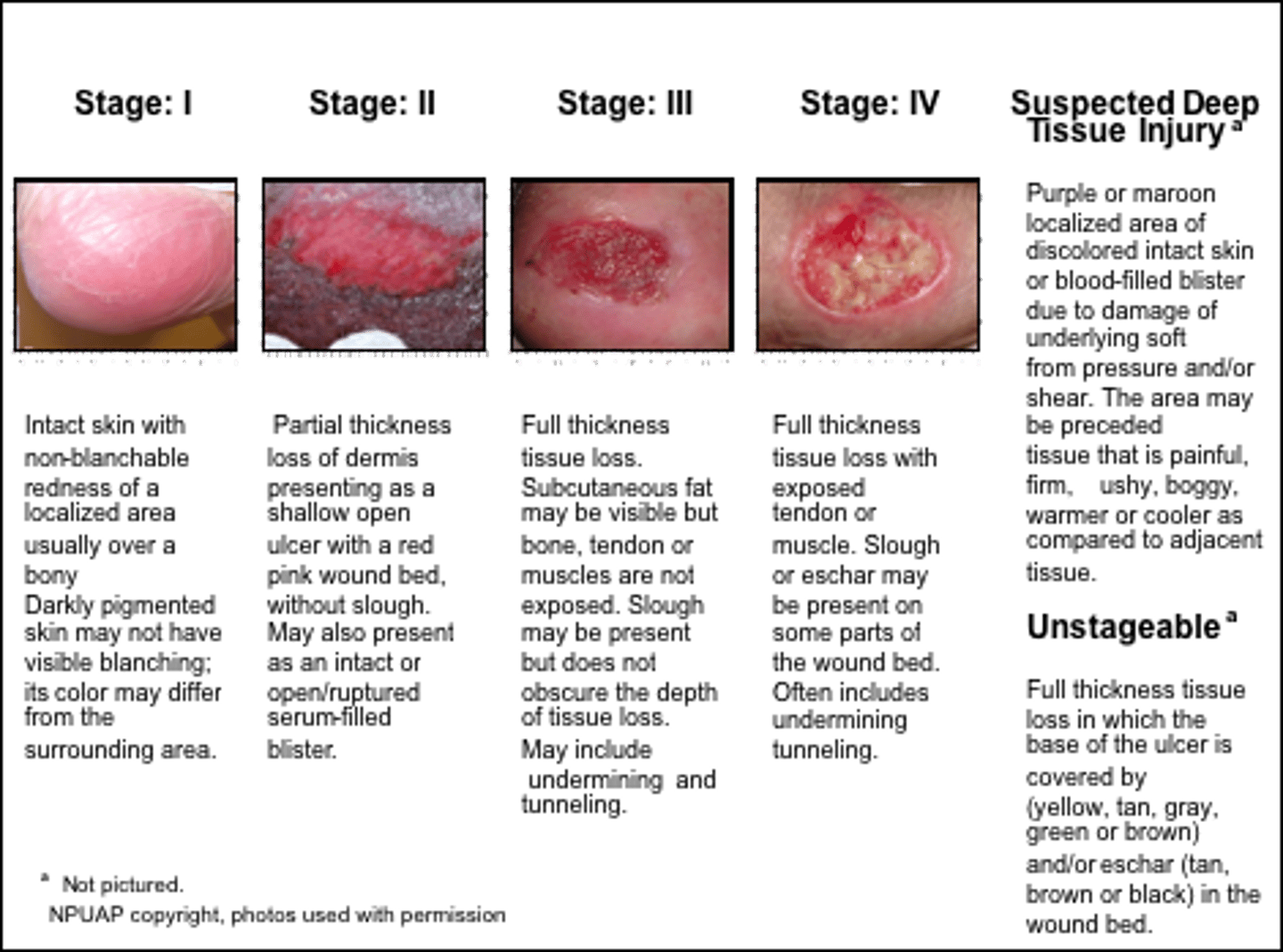 <p>stage 1 - nonblanchable erythema of intact skin, reversible with intervention (also discoloration, warmth, edema)</p><p>stage 2 - partial-thickness skin loss (epidermis and dermis involved, presents as abrasion, blister, or shallow crater</p><p>stage 3 - full-thickness skin loss; into fat layer but not involving underlying fascia</p><p>stage 4 - full-thickness skin loss with extensive destruction, beyond fascia and muscle, tendons or capsule may be exposed, ulcer may extend to bone and bone destruction</p><p>unstageable - base of ulcer covered by slough and/or eschar in wound bed</p>