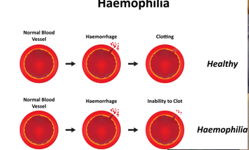 <p>inherited, life-threatening disorder </p><p>causes: insufficient blood clotting proteins</p><p>treated with coagulation protein injectioins</p>