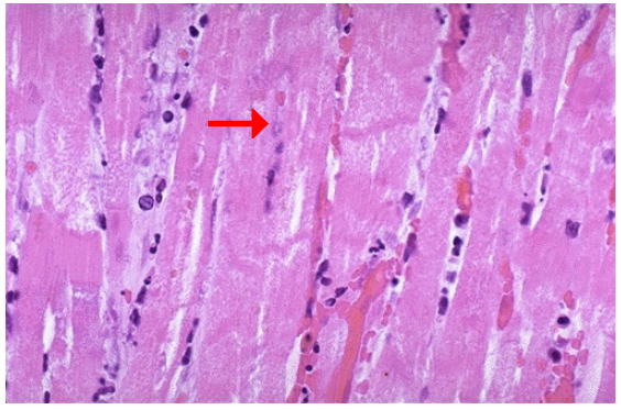 <ol><li><p>Identify the type of cell death and CD</p></li><li><p>What symptom may accompany this pathology?</p></li></ol><p></p>
