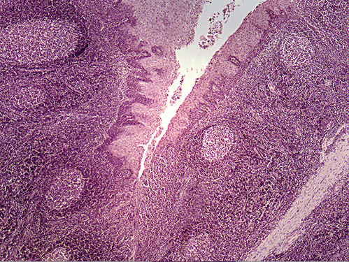 <p><span>This photomicrograph illustrates diffuse lymphatic tissue found just deep to the stratified squamous <strong>epthelium</strong> in the walls of the pharynx.</span></p>