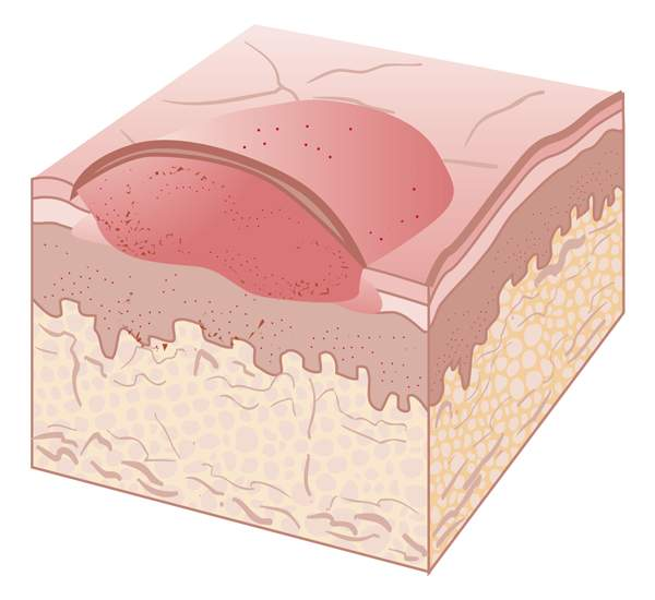<ul><li><p><span style="line-height: inherit;">solid, elevated, flat-top lesion with indistinct borders</span></p></li><li><p><span style="line-height: inherit;">It is found on the skin or mucous membrane</span></p></li><li><p><span style="line-height: inherit;">Thrush is an example of plaque</span></p></li></ul><p></p>