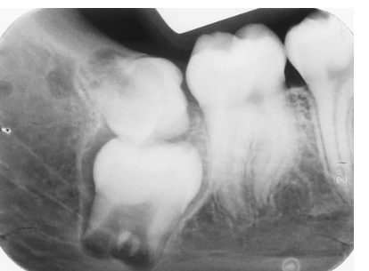 <p>List the anomalies seen in this radiograph of the 3rd molar region.</p><p> </p><p>Impacted 2nd molar and microdontic 3rd molar</p><p> </p><p>Impacted 3rd molar and supernumerary 4th molar</p><p> </p><p>Impacted 2nd molar; microdontic, impacted 3rd molar; and dilacerated mesial root of the 2nd molar</p><p> </p><p>Impacted 3rd molar; impacted, supernumerary 4th molar; and dilacerated mesial root of the 2nd molar</p>