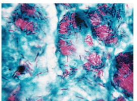 <ul><li><p>Mycobacteria have a thick cell wall (~60% lipid, less peptidoglycan than Gram +)</p></li><li><p>Lipid-rich wall slows nutrient and agent flow → slow growth and high energy demand for wall synthesis</p></li><li><p>Example: <em>Mycobacterium tuberculosis</em> stains red with carbolfuchsin</p></li></ul><p></p>