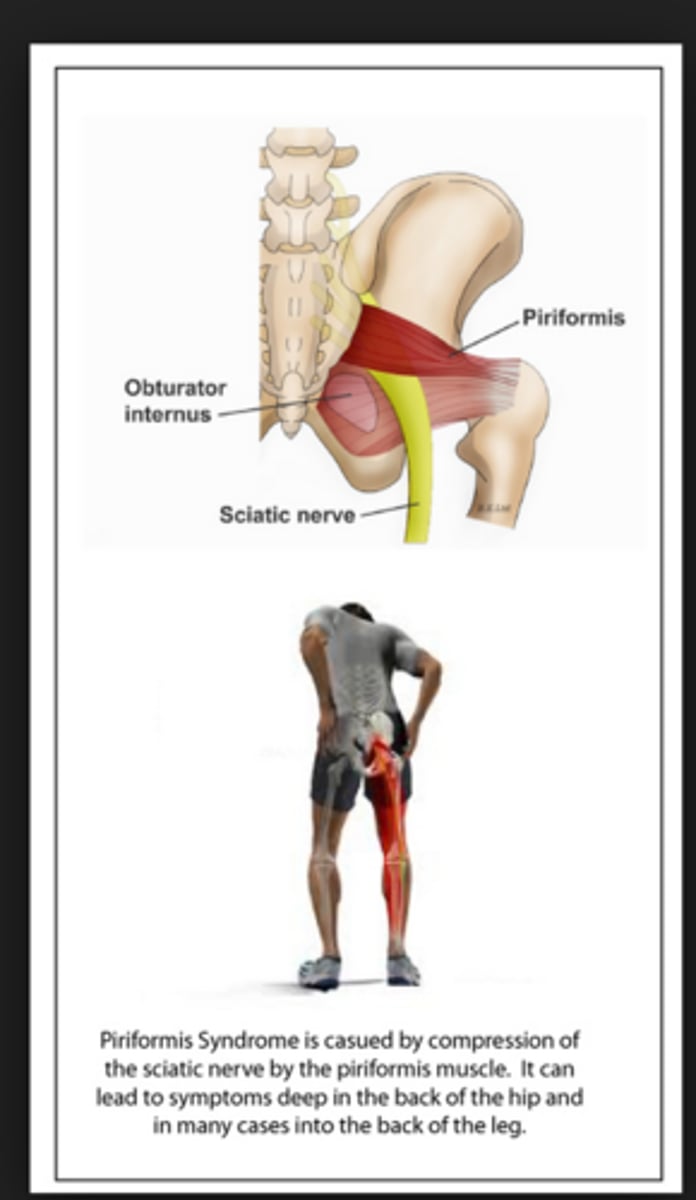 <p>compression of the sciatic nerve by the piriformis muscle</p><p>*sciatica</p><p>**lumbosacral dysfunction</p>