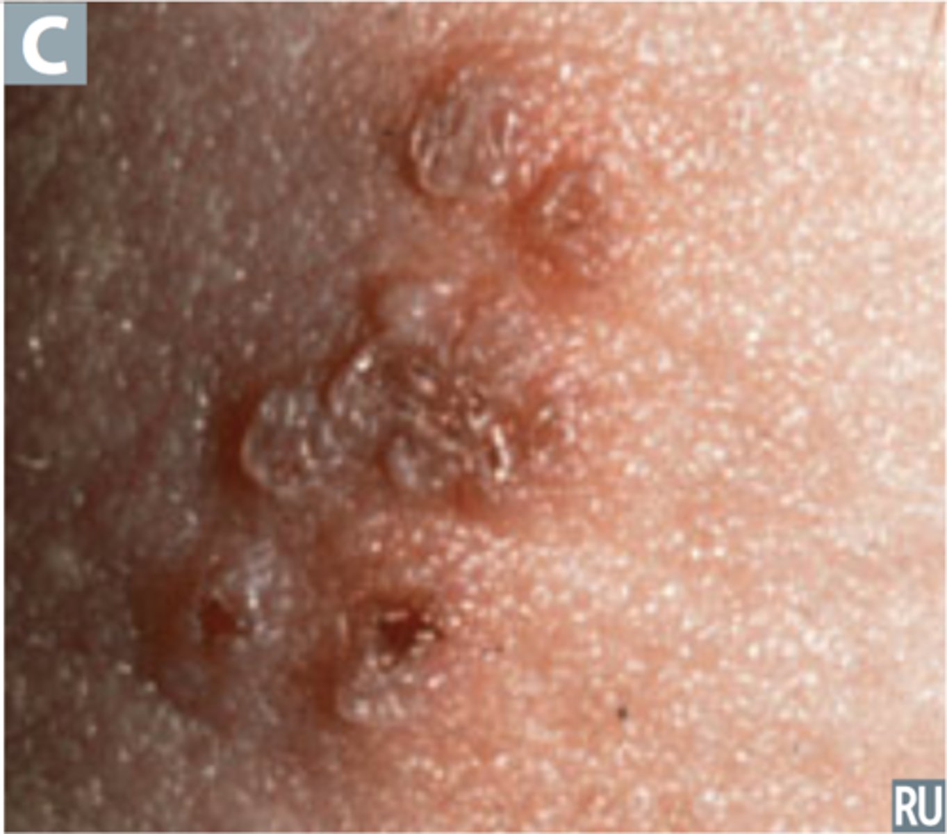 <p>Itching, then vesicular eruptions that break and crust, cause scarring</p>