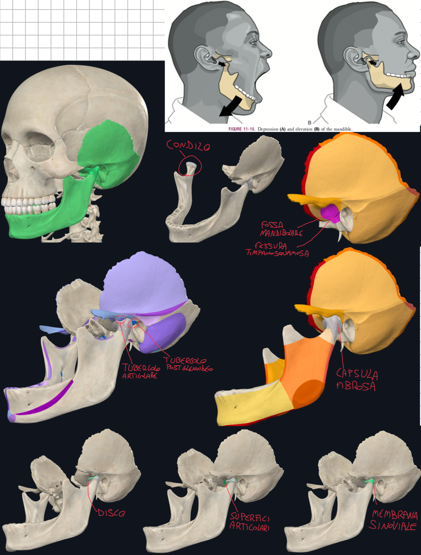 <p>Tipo → articolazione mobile sinoviale, l’unica nel cranio</p><p>Superfici articolari:</p><ul><li><p>Condilo della Mandibola (rivestita da cartilagine articolare):</p><ul><li><p>le superfici articolari sono rivestite da non da ialina ma da fibrocartilagine → questo per resistere meglio alle enormi forze meccaniche dovute alla masticazione</p></li></ul></li><li><p>Fossa Mandibolare dell’Osso Temporale (parte squamosa):</p><ul><li><p>Solo la parte anteriore della fossa è articolare → la fessura timpano-squamosa separa la porzione articolare da quella non articolare</p></li></ul></li></ul><p>Strutture Ossee Accessorie:</p><ul><li><p>Tubercolo Postglenoideo → all’estremità laterale della fessura timpano-squamosa, tra parte timpanica e squamosa → limita i movimenti all’indietro (retrazione) del condilo</p></li><li><p>Tubercolo Articolare (anteriore) → parte integrante della superficie articolare → in caso di apertura molto ampia della bocca, il condilo si sposta fuori dalla fossa mandibolare sotto il tubercolo articolare.</p></li></ul><p>Disco Articolare:</p><ul><li><p>Presente all’interno della Capsula Fibrosa che racchiude l’articolazione ed è ancorato intorno alla membrana sinoviale che riveste la faccia interna della capsula e si inserisce sui margini delle superfici articolari.</p></li><li><p>Divide la cavità articolare in:</p><ul><li><p>Compartimento Superiore per i movimenti di traslazione → scivolamento in avanti e in basso del condilo quando si apre più ampiamente la bocca (il condilo si sposta fuori dalla fossa mandibolare sotto il tubercolo articolare)</p></li><li><p>Compartimento Inferiore per i movimenti di rotazione → abbassamento e sollevamento lieve della mandibola (movimento rotatorio con il condilo che ruota sotto al disco)</p></li></ul></li></ul><p>Lussazione della Mandibola:</p><ul><li><p>Avviene in caso di apertura eccessiva o spinta improvvisa (laterale o posteriore) dove il condilo e il disco superano il tubercolo articolare</p></li><li><p>La mandibola resta bloccata in apertura e il pz non riesce a chiudere la bocca</p></li><li><p>Per trattarla il medico afferra i rami mandibolari per abbassarli e spingerli contemporaneamente all’indietro → così il condilo ritorna nella fossa mandibolare</p></li></ul><p></p>