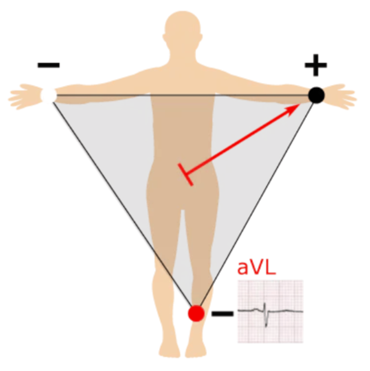 <p>Right half --> left arm; produces a positive waveform as heart's electrical activity naturally moves down &amp; to the left</p>