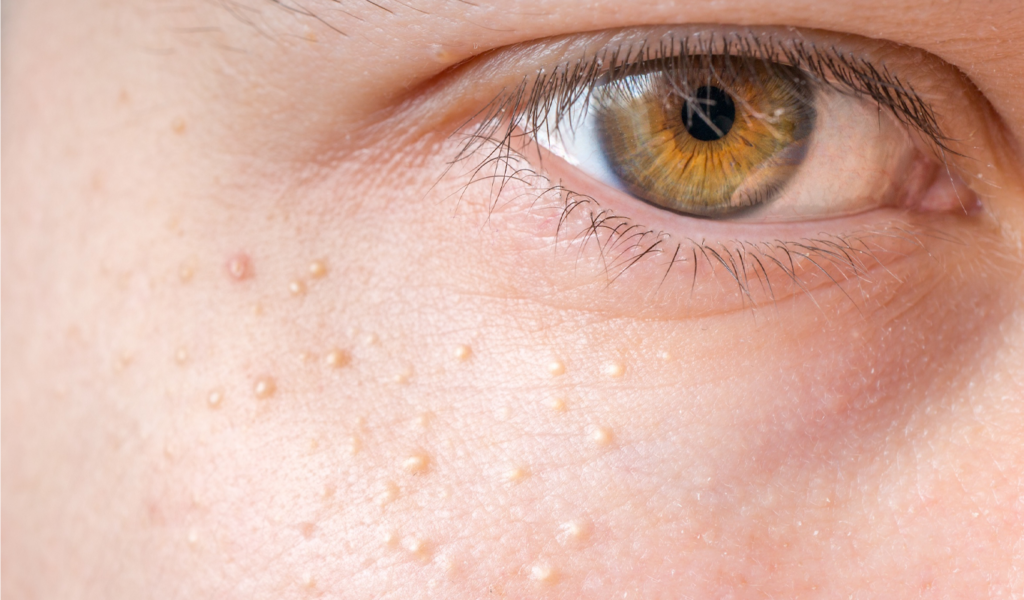 <p>tiny white papule on cheek and forehead and across nose and skin (caused by sebum that occludes the follicles) </p>