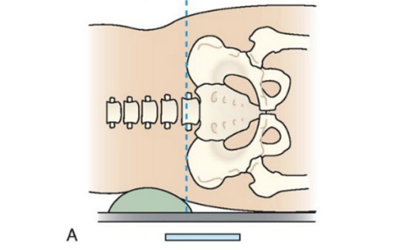 <p>transects the pelvis at the top of the iliac crest at the 4th lumbar spinous process (L4). utilized for positioning in the lumbar spine, sacrum, and coccyx</p>