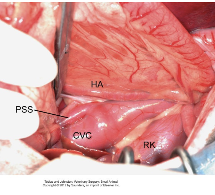 <p>- Congenital: Direct communication with the portal venous system and systemic circulation (bypasses liver) which are commonly single and can be intra- or extrahepatic</p><p>- Acquired: Secondary to chronic portal hypertension which are more commonly multiple, torturous and extrahepatic</p>