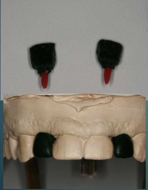 <ul><li><p>send case to lab or i can do waxup </p></li><li><p>use plastic/wooden stick that fits the inside of the implant analog </p></li><li><p>modify height and do crown wax up </p></li><li><p>check/evaluate on cast</p></li></ul><p></p>
