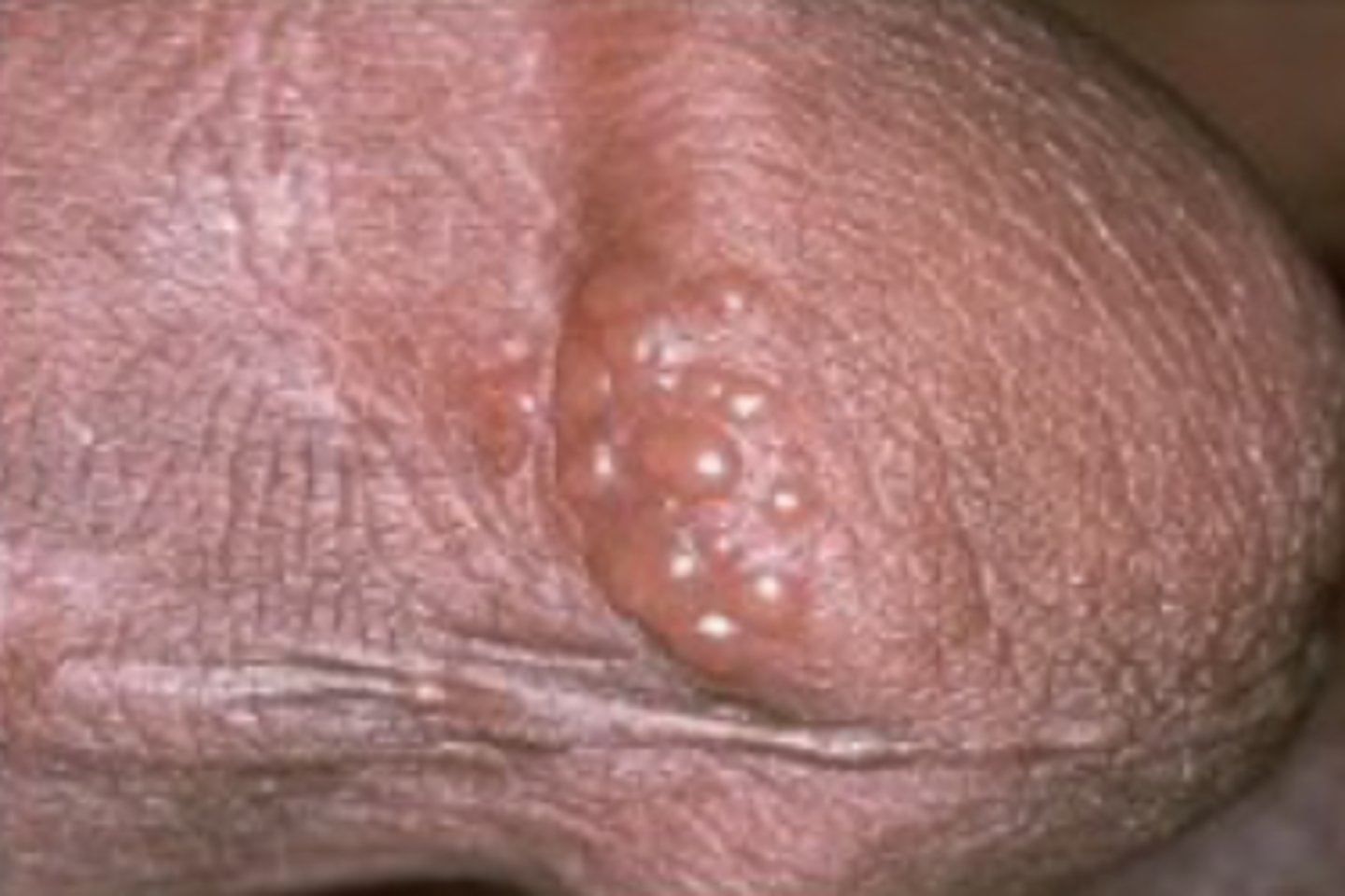 <p>= zichtbare holte gevuld met helder vocht, zonder eigen wand &lt; 1 cm gelokaliseerd in de epidermis</p>