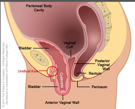 <p>What is seen post hysterectomy?</p>
