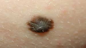 <p>What type of skin lesion is this? Give an example.</p>