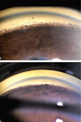 <p>what is the finding shown in this image? </p>