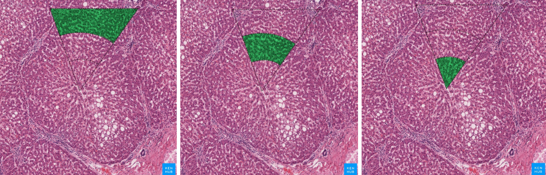<p>La unidad funcional del acino hepatico tiene forma ovalada.El eje corto está representado por un borde compartido entre dos lobulillos adyacentes junto con los canales portales. El eje largo es una línea imaginaria entre dos venas centrales adyacentes. Cada mitad del acino hepático puede dividirse en tres zonas:</p><ul><li><p>Zona 1: Se considera la región periportal de los hepatocitos y es la mejor perfundida y la primera en regenerarse debido a su proximidad a la sangre oxigenada y a los nutrientes. Debido a su alta perfusión, la zona I desempeña un papel importante en la gluconeogénesis, la formación de bilis.</p></li><li><p>Zona 2: Se define como la región pericentral de los hepatocitos y se sitúa entre las zonas I y III.</p></li><li><p>Zona 3: Tiene la perfusión más baja debido a su distancia de la tríada portal. Desempeña el papel más importante en la desintoxicación, la glucólisis, la lipogénesis.</p></li></ul>