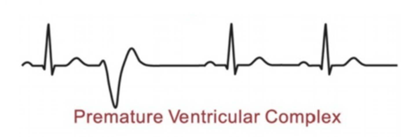 <p>No P wave<br>Large and inverted T wave<br>Premature and bizarrely shaped QRS complex</p>