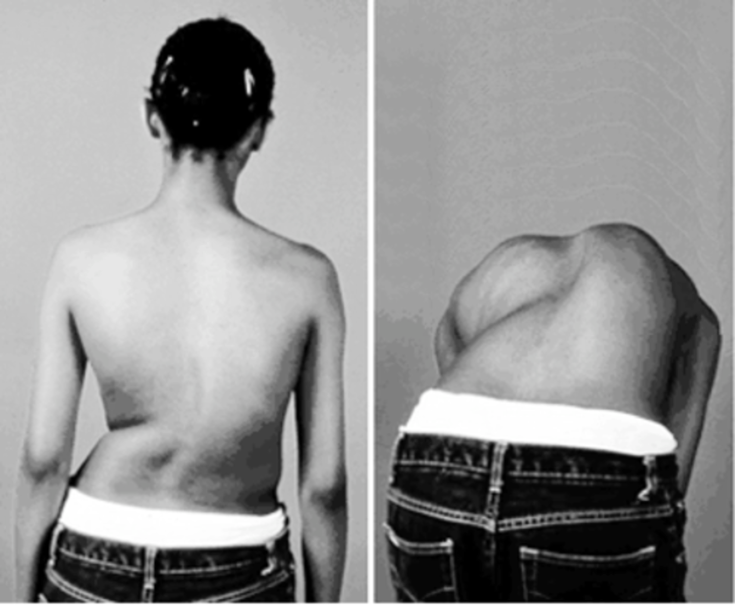 <p>they have a posterior elevation on one side of the thorax 6mm or greater</p>