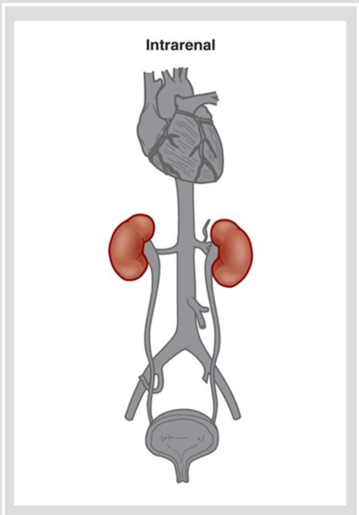 <p>Etio and Patho<br><br>Intrarenal</p><ul><li><p>causes include conditions that cause direct damage to kidney tissue</p><ul><li><p>prolonged ischemia</p></li><li><p>nephrotoxins drugs</p><ul><li><p><strong>vancomycin</strong></p></li><li><p><strong>metformin</strong></p></li><li><p><strong>glycoside</strong></p></li><li><p><strong>oral contrast</strong></p></li><li><p><strong>chemo drugs</strong></p></li></ul></li></ul></li><li><p>Hemoglobin released from hemolyzed RBC</p></li><li><p>Myoglobin released from necrotic muscle cells</p></li></ul><p></p>