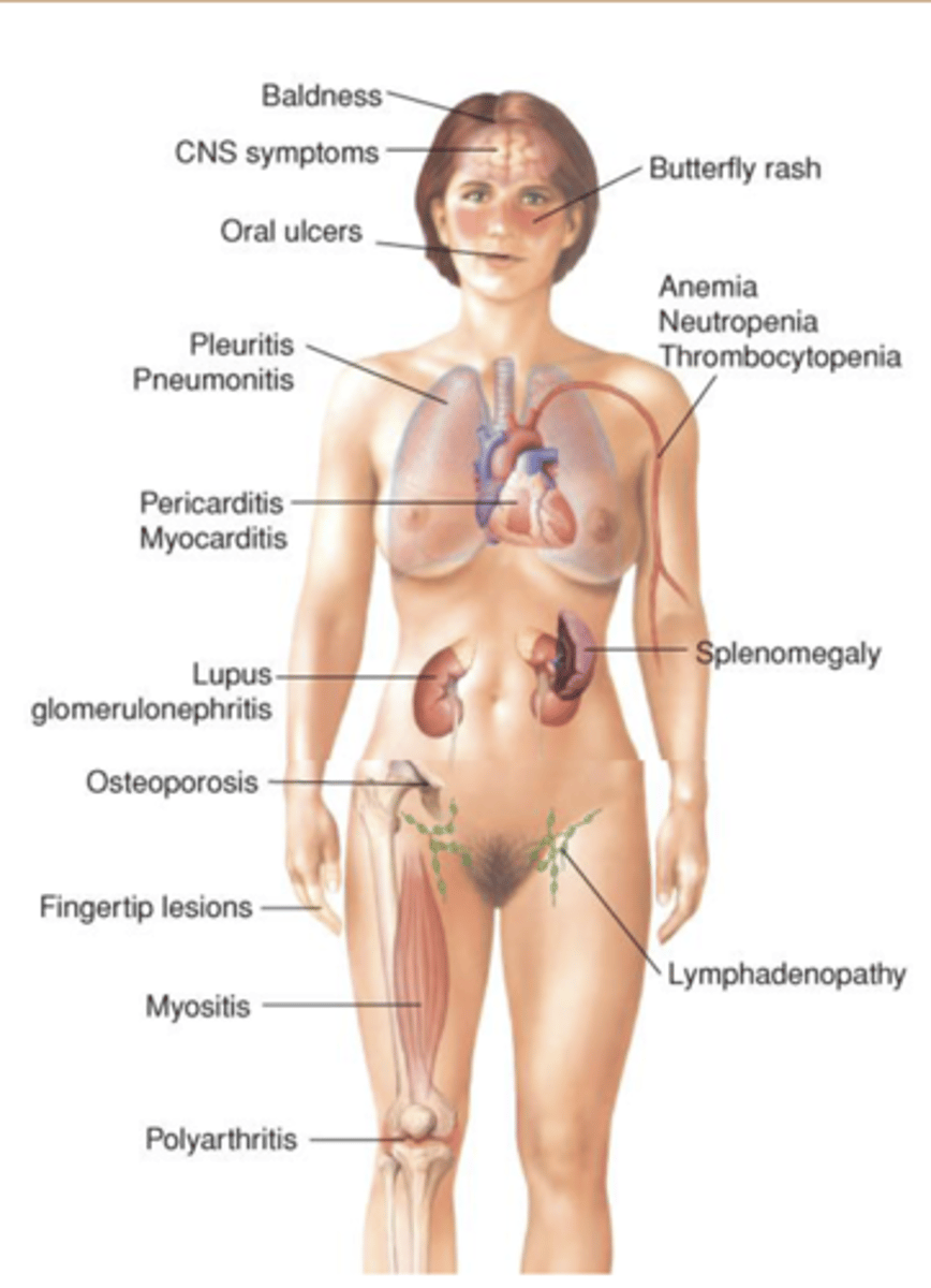 <p>Chronic autoimmune disease that can affect any organ system</p><p>-- “The great imitator”</p><p>-- Widespread inflammation and tissue damage</p><p>--- Joints, skin, brain, lungs, kidneys, blood vessels</p><p>-- Blood test: anti-nuclear Ab (ANA)</p><p>Primarily seen in young females (15-40 years)</p><p>-- Incidence higher in some families</p><p>butterfly rash </p>
