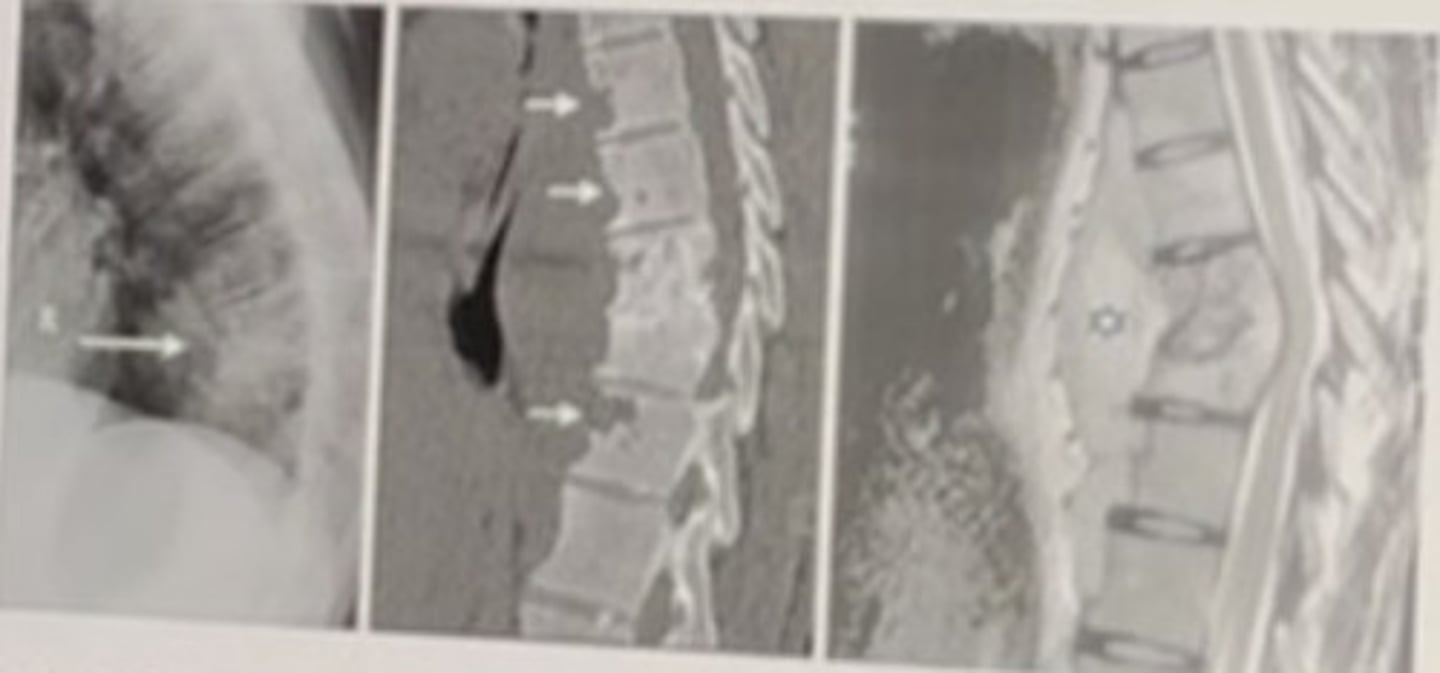 <p>54 year old homeless man with chronic severe mid back pain and also complains of having a long standing cough.</p><p>Which triad may be seen with involvement of the above condition in the extremities.</p><p>• Gardners</p><p>• McCune's</p><p>• Puttis</p><p>• Phemister's</p>