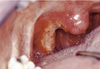 <p>the lesion has been present for 3 weeks, what is the concern with this lesion </p>