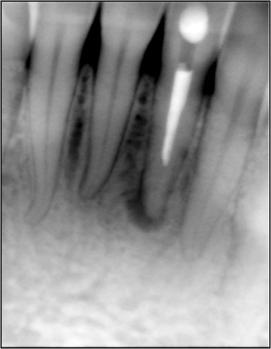 <p>What is the cause of this apical radiolucency?</p>