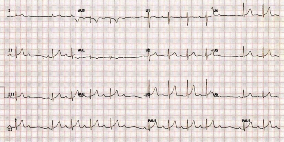 <p>what rhythm is shown in the ECG?</p>